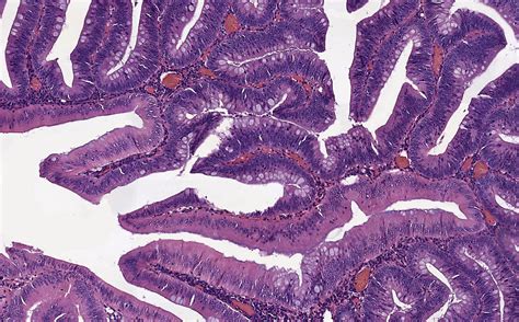 Tubular Adenoma Histology