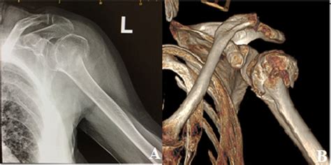 (A) X-Ray radiograph of the left shoulder showing a comminuted proximal... | Download Scientific ...