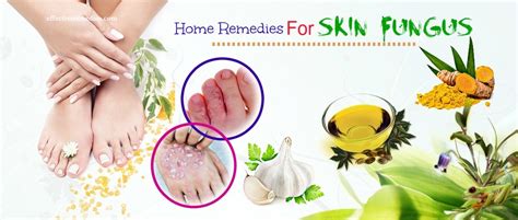 25 Effective Home Remedies For Skin Fungus On Hands & Feet