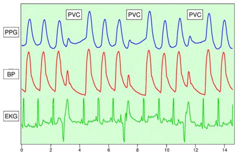 Pulse Oximeter Pleth (Plethysmograph): AmperorDirect