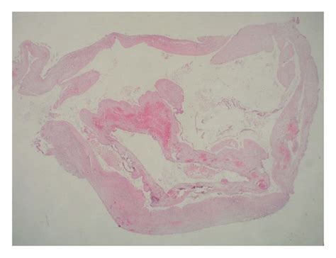 (a) Histology: overview of the cystic tissue with focally intact ...