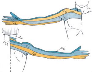 Cervical Radiculopathy Dermatome Map