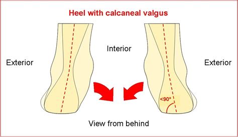 VALTAG Insoles with arch support