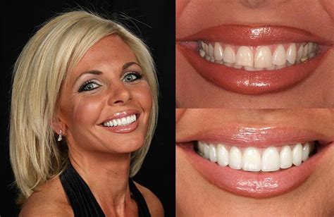 Layton Dental Porcelain Veneers Process - Layton Hills Dental