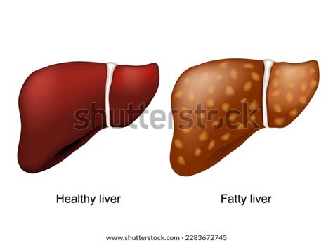 Fatty Liver Disease Healthy Liver Hepatic Stock Vector (Royalty Free) 2283672745 | Shutterstock