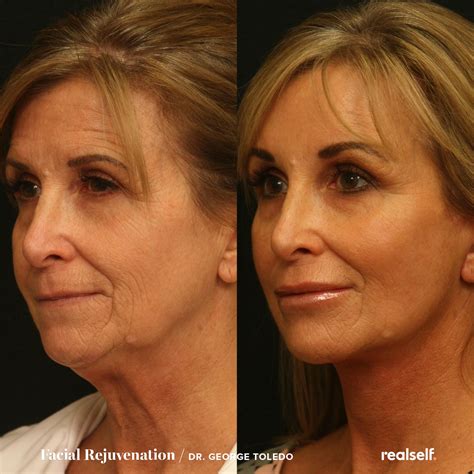 Facelift Surgery (Rhytidectomy): The Ultimate Guide | RealSelf | Face plastic surgery, Fat ...