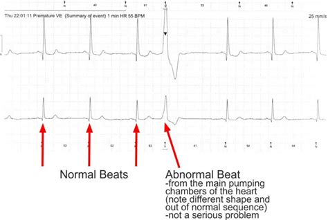 Ambulatory ECG (Ambulatory Electrocardiogram)