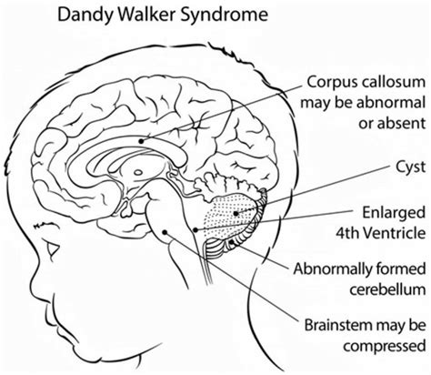 Dandy Walker syndrome causes, symptoms, diagnosis, treatment & prognosis