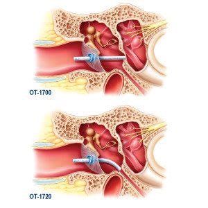 SILVERSTEIN MICROWICK EAR WICK FOR DRUG DELIVERY (1 KIT) | ENT Supplies