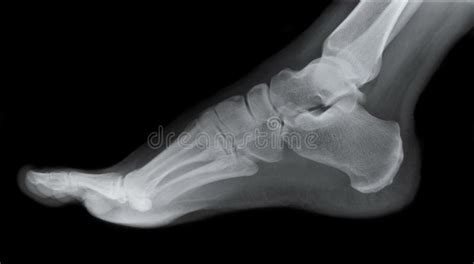 Right Foot Side X-ray stock image. Image of bone, hospital - 23580309