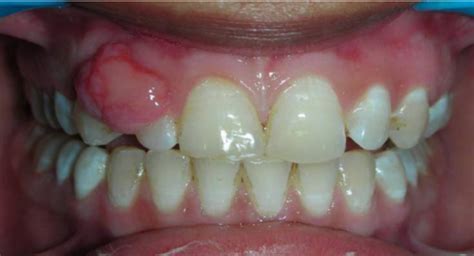 Clinical photograph showing typical presentation of peripheral... | Download Scientific Diagram