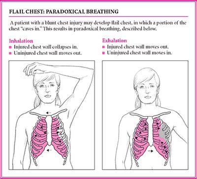 Blunt-Force Trauma : Interventions for Flail Chest