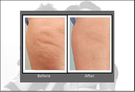 Cellulite Treatment | Cellulaze™ Laser Procedure | Hartford CT