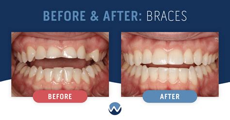 How Braces Change Face Shape (Before & After)