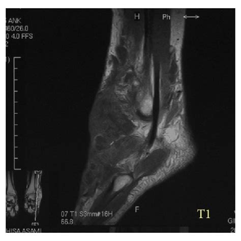 MRI showing an ill-defined heterogeneous soft tissue mass. T1 weighted... | Download Scientific ...