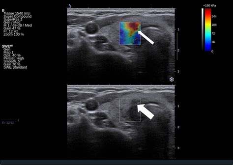 Patient 2. Small area of decreased, heterogeneous echogenicity at the ...