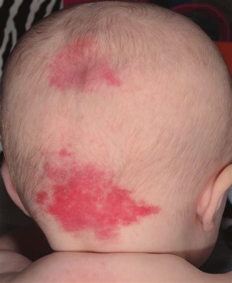 Study Medical Photos: Nevus Simplex Or A Salmon Patch - A Vascular ...