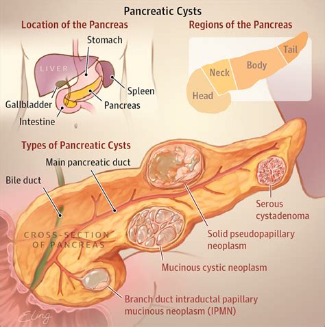 Types of Pancreatic Cysts | Gastroenterology | JAMA | JAMA Network | Diagnostic medical ...