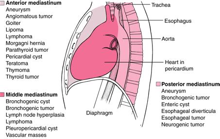 Mediastinal Tumors — Suncoast Surgical Associates