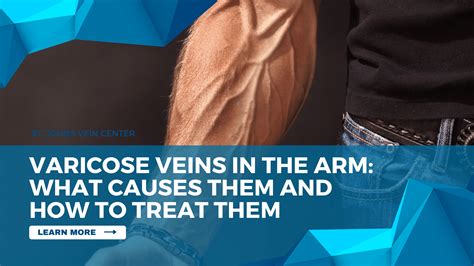 Varicose Veins In The Arm: Causes And How To Treat Them - St Johns Vein Center