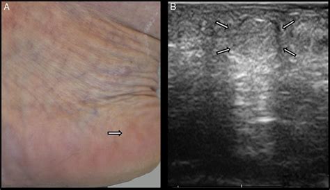 Usefulness of High-Frequency Ultrasound in the Diagnosis of Piezogenic ...