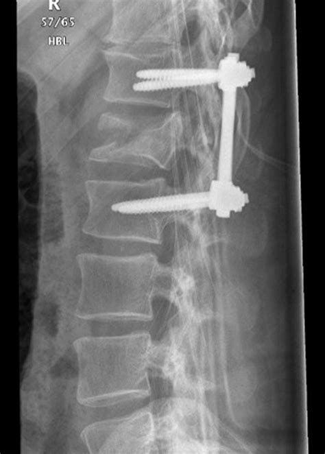 Icd 10 Code For Closed Fracture 4th Vertebrae