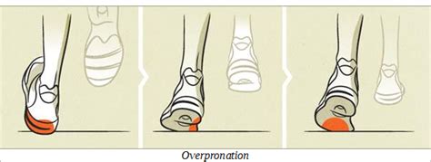 What Body Parts Can Be Affected by Overpronation