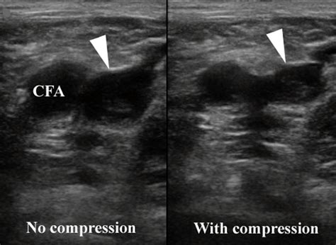 DVT Images | Emergency Ultrasonography