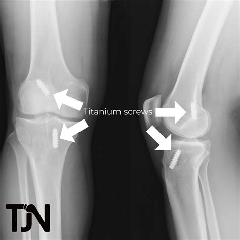 All About ACL Reconstruction - TJN Ortho