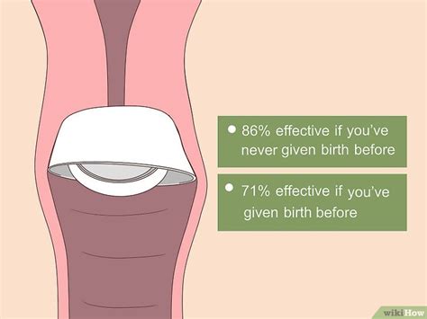 How to Use a Cervical Cap - wikiHow