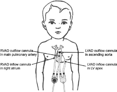 Cannulation for BiVAD in a child. Image reprinted and modified with ...