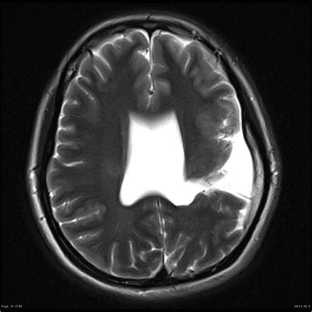 Viewing playlist: Congenital malformations CNS (iOS pack) | Radiopaedia.org