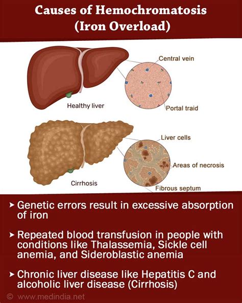 Hemochromatosis (Iron Overload) - Causes, Symptoms, Diagnosis ...