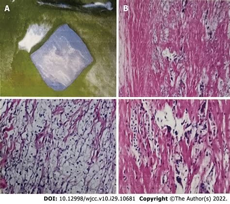 Tendinous Xanthoma Histology