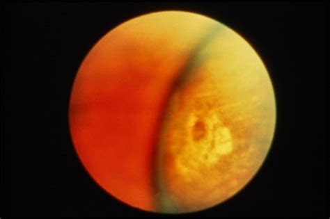 SPOTLIGHT ON Atrophic Retinal Holes - Ophthalmology Education