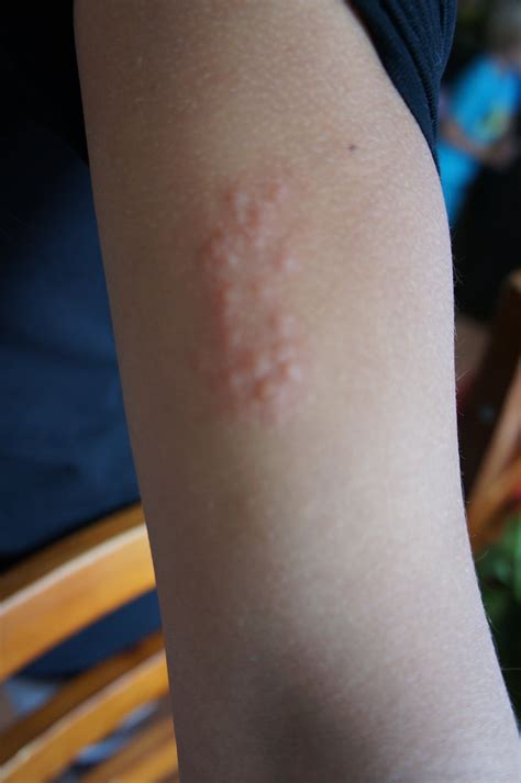 Small Rash Bumps On Arms | Images and Photos finder