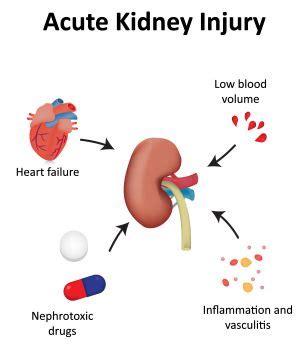 10 AKI facts - Chronic Kidney Disease Explained