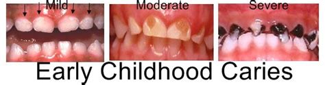 Baby Bottle Tooth Decay, or Early Childhood Caries (EEC) is most common ...