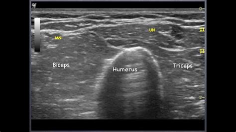 Ulnar Nerve Elbow Ultrasound | Images and Photos finder