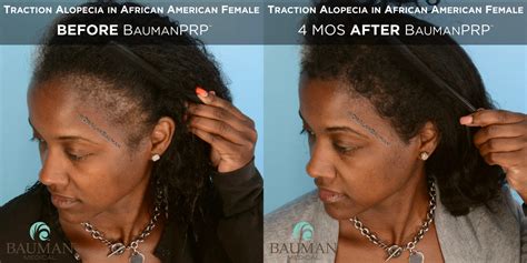 Traction Alopecia in African American BaumanPRP · Bauman Medical