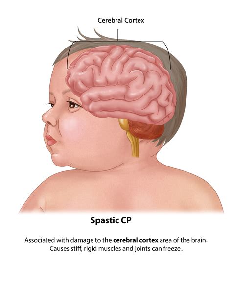 Types of Cerebral Palsy | Brain Injury Lawyers