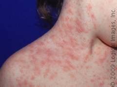 Pityriasis Rosea – Pictures, Causes, Symptoms and Treatment