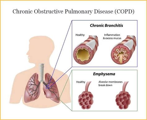 Copd And Coughing Up Mucus