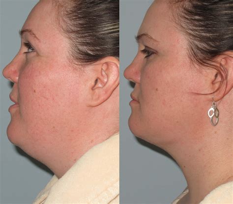 Double Chin Radio Frequency Liposuction | Double Chin Liposuction By LLV