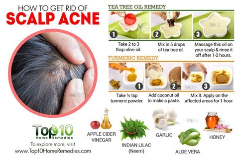 How to Get Rid of Scalp Acne | Top 10 Home Remedies