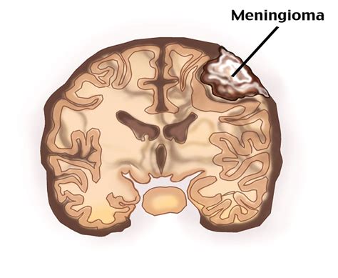 Meningioma Symptoms, Causes, Diagnosis and Treatment - Natural Health News