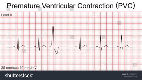 Electrocardiogram Show Premature Ventricular Contraction Pvc Stock Vector (Royalty Free ...