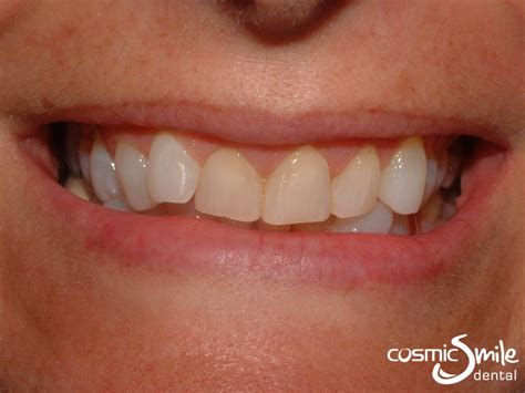 Lumineers in Sydney - Before and After - Cosmic Smile Dental