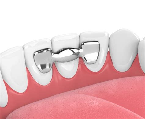 3d Render of Jaw with Teeth and Maryland Bridge Stock Illustration ...