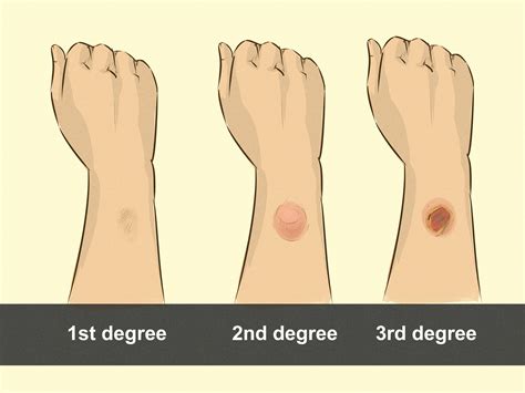 3 Ways to Treat a Chemical Burn - wikiHow